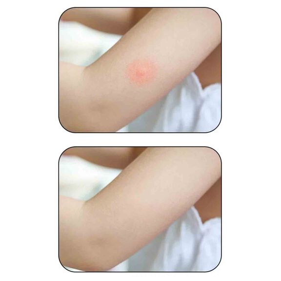 Sting Stick Bug Bite Relief Rechargeable Pen image number 5